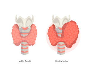 Thyroid Profile Total