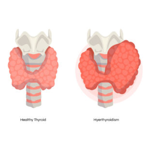 Thyroid Profile Total